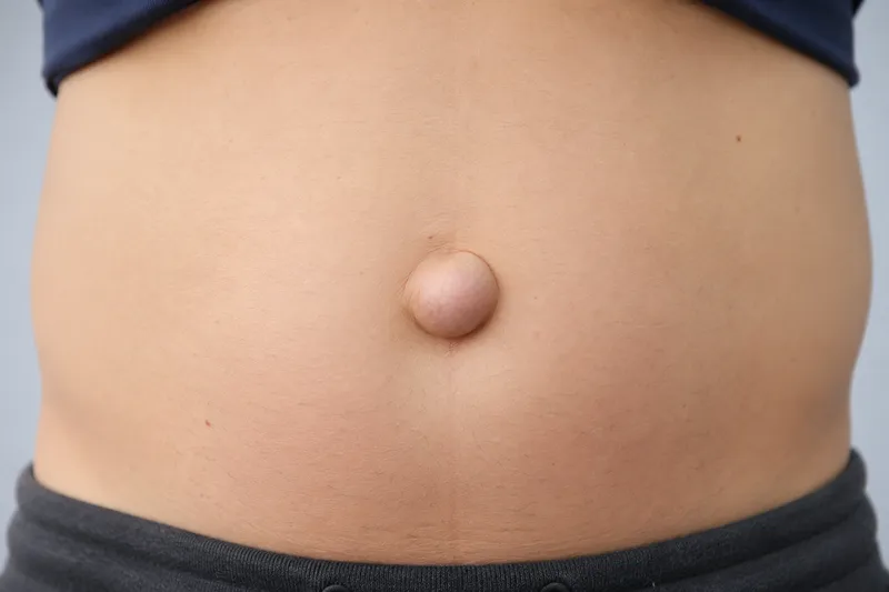 Umbilical hernia surgery consultation in Poland